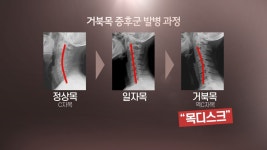 목 디스크 부르는 거북목 증후군…예방법은 | 연합뉴스