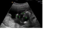 아기 성별 판별 부탁드려요^^* (사진 설명 추가했어요)