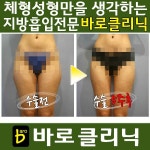하체지방흡입,허벅지지방흡입 전문 바로클리닉