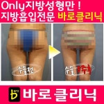 하체지방흡입,허벅지지방흡입 전문 바로클리닉