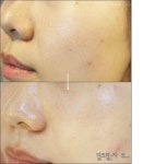 밀크필 받고 왔어요 / 대구 상인동 박앤리피부과