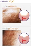 부평여드름한의원 흉터없이 깨끗한피부 만들기