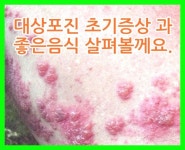 대상포진 초기증상 과 대상포진에 좋은 음식