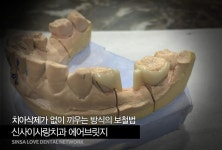 어금니브릿지 잘하는 논현역치과 신사이사랑!