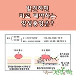 발견하면 바로 떼야하는 양성종양은?