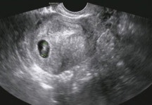7주4일 아기 심정지로 유산