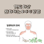 햇빛 화상 완화하는 9가지 방법