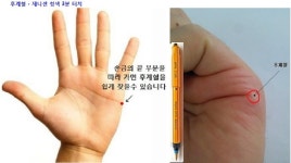 제니센이라는 기구를 이용한 엘보어 치료방법입니다 - 엘보어 자료방... (비염,안구건조,이명,노안,동안침,두통전문) 제니센이라는 기구를 이용한... 