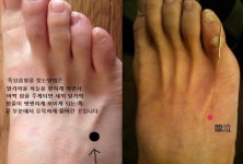 고관절 통증 / 고관절염 원인과 제니센 터치 방법 - ▣ 제니센 터치... 삶을 열어가는 힐링라이프 고관절 통증 / 고관절염 원인과 제니센 터치 방법