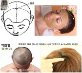 제니센 치료법(비염 치료의 끝판 왕!) - ▣ 제니센 터치 치유상담 - 건강한 삶을 열어가는 힐링라이프 환절기에 심해지는 알레르기성 비염 제니센... 