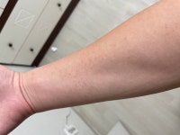자고 일어났는데 팔에 빨간점이 많이 있습니다 ㅣ 궁금할 땐, 아하!