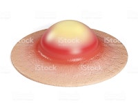 Zit - 膿瘍のストックフォトや画像を多数ご用意 - iStock Pimple on the skin close-up. Zit isolated