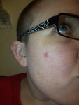 Painful Zit. Painful zit | by Chanel Silver | Medium Painful Zit