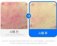 [1일 진정] 다이버 아내를 위해 개발한 하루면 진정되는 하루 진정 크림