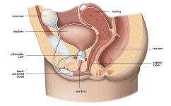 [보고서]요실금 환자를 위한 인공요도괄약근에 집적될 체내삽입용 방광볼륨 센서 개발