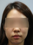 KR20170032026A - 윤곽주사 조성물 - Google Patents