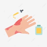피부약, 발진, 가려움, 케어 PNG, 일러스트 및 벡터 에 대한 무료 다운로드 - Pngtree