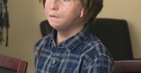 Wonder Movie Auggie Condition Name Facial Deformity Whats Auggies Condition In The Movie "Wonder"?