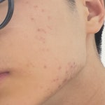 피부 곱창난거 언젠가는 나아짐? | 오르비 피부 곱창난거 언젠가는 나아짐? - 오르비