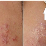 함 Diagnosis of acne#여드름 #여드름진단 #여드름진단법 #acne #acnediagnosis#청주피부과 #매어리벳의원#메어리벳클리닉 #Marybethclinic