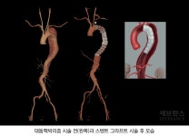 대동맥박리 [Aortic dissection] | 세브란스병원