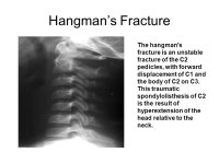 C- Spine Adult vs Pediatric -  ppt video online download