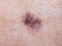 그냥 피부에 난 점인줄 알고 놔뒀다가 위험한 암이 될 수도 있다