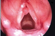 성대폴립 치료법 성대폴립 완치법 성대폴립 원인 성대폴립 관리법 - newscast - Medicine News 성대폴립 치료법 성대폴립 완치법 성대폴립... 