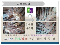 [청주탈모][청주두피관리] 청주두피관리의 명가 모사랑 - 탈모예방법 - 메이리스칼프 두피탈모관리전문센터 [청주탈모][청주두피관리]... 