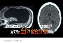 “머리가 너무 크다”며 병원 찾은 남성에게는 뇌가 없었다 - 악플달면... 알흠다운 공간 “머리가 너무 크다”며 병원 찾은 남성에게는 뇌가 없었다