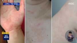 스타벅스 가방 쓴 뒤부터... 피부 발진에 호흡곤란까지 - 악플달면... 20대들의 알흠다운 공간 스타벅스 가방 쓴 뒤부터... 피부 발진에 호흡곤란까지
