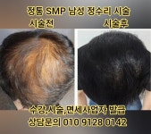 대한두피탈모커버협회부미인두미각 | 두피문신 남성 정수리 두미각 자연침법 시술 - 동영상과 사진 및 가격 - 사)SMP두미각,합법면세교육기관 두피문신 남성 정수리 두미각 자연침법...