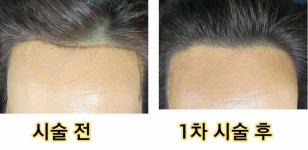 제이도트스칼프SMP두미각 | 두피문신 네츄럴한 시술과 퀄리티로 가성비 만족도 전국 1위 - 동영상과 사진 및 가격 - 사)SMP두미각,합법면세교육기관 두피문신 네츄럴한...