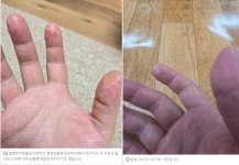 한병 먹고 한포진이 완전히 달라졌습니다. - ♣구매후기 게시판♧ - 남도향프로폴리스 프로폴리스 한병 먹고 한포진이 완전히 달라졌습니다.