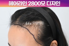 [30대 여자 깊은 M자 헤어라인 머리심기] 비절개 히든컷 모발이식 2800모 1년 후기 (모엠의원/헤어라인/전지훈원장) - 헤어라인 - 모엠의원 여성... 