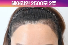 [40대 여자 M자 비대칭 헤어라인 머리심기] 비절개 히든컷 모발이식 2500모 1년 후기 (모엠의원/헤어라인/전지훈원장) - 헤어라인 - 모엠의원... 