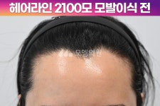 헤어라인 - 모엠의원 여성 후기-히든컷, 헤어라인교정, 탈모치료, 재수술 [30대 여자 깊은 M자이마 헤어라인 교정수술] 비절개 히든컷... 