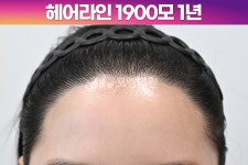[30대 여자 M자이마 헤어라인 교정수술] 비절개 히든컷 모발이식 1900모 1년 후기 (모엠의원/헤어라인/전지훈원장) - 헤어라인 - 모엠의원 여성... 