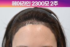 후기 (모엠의원/헤어라인/전지훈원장) - 헤어라인 - 모엠의원 여성 후기-히든컷... 모발이식 2300모 1년 후기 (모엠의원/헤어라인/전지훈원장)