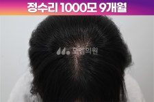 모엠의원 여성 후기-히든컷, 헤어라인교정, 탈모치료, 재수술 [30대 여자 정수리 머리심기] 비절개 히든컷 모발이식 1000모 1년 후기 (모엠의원... 