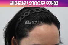 후기 (모엠의원/헤어라인/전지훈원장) - 헤어라인 - 모엠의원 여성 후기-히든컷... 2100모 1년1개월 후기 (모엠의원/헤어라인/전지훈원장)