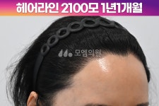 [30대 여자 깊은 M자이마 헤어라인 교정수술] 비절개 히든컷 모발이식 2100모 1년1개월 후기 (모엠의원/헤어라인/전지훈원장) - 헤어라인... 