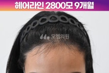 [30대 여자 깊은 M자 헤어라인 머리심기] 비절개 히든컷 모발이식 2800모 1년 후기 (모엠의원/헤어라인/전지훈원장) - 헤어라인 - 모엠의원 여성... 