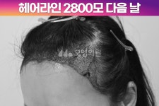 [30대 여자 깊은 M자 헤어라인 머리심기] 비절개 히든컷 모발이식 2800모 1년 후기 (모엠의원/헤어라인/전지훈원장) - 헤어라인 - 모엠의원 여성... 