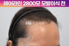 [20대 여자 M자 헤어라인 비절개 모발이식] 히든컷 2800모 1년 후기 (모엠의원/헤어라인/전지훈원장) - 헤어라인 - 모엠의원 여성 후기-히든컷... 