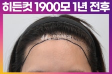 후기 (모엠의원/헤어라인/전지훈원장) - 헤어라인 - 모엠의원 여성 후기-히든컷... 모발이식 1900모 1년 후기 (모엠의원/헤어라인/전지훈원장)