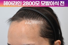 [20대 여자 M자 헤어라인 비절개 모발이식] 히든컷 2800모 1년 후기 (모엠의원/헤어라인/전지훈원장) - 헤어라인 - 모엠의원 여성 후기-히든컷... 