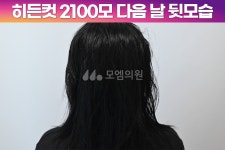 [30대 여자 깊은 M자이마 헤어라인 교정수술] 비절개 히든컷 모발이식 2100모 1년1개월 후기 (모엠의원/헤어라인/전지훈원장) - 헤어라인... 