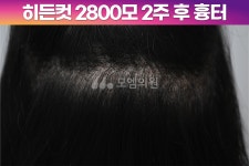 [30대 여자 깊은 M자 헤어라인 머리심기] 비절개 히든컷 모발이식 2800모 1년 후기 (모엠의원/헤어라인/전지훈원장) - 헤어라인 - 모엠의원 여성... 