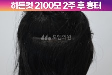 헤어라인 - 모엠의원 여성 후기-히든컷, 헤어라인교정, 탈모치료, 재수술 [30대 여자 깊은 M자이마 헤어라인 교정수술] 비절개 히든컷... 